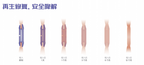 正式啟動(dòng)臨床應(yīng)用！全國(guó)首批生物可降解房缺封堵術(shù)圓滿成功！